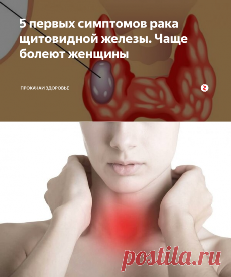 5 первых симптомов рака щитовидной железы. Чаще болеют женщины | ПРОКАЧАЙ ЗДОРОВЬЕ | Яндекс Дзен