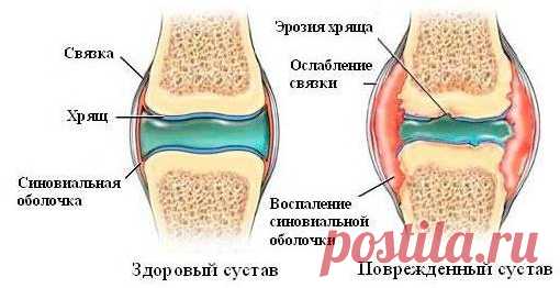 Лучшие рецепты для очищения суставов - Страна Полезных Советов - медиаплатформа МирТесен