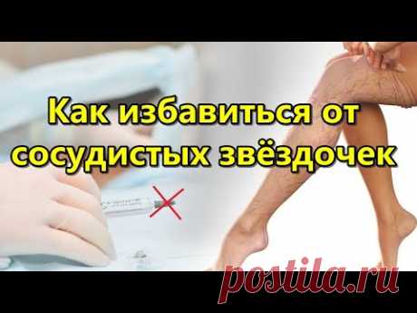 Как избавиться от сосудистых звёздочек