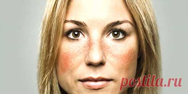 Красная волчанка: симптомы и лечение народными средствами