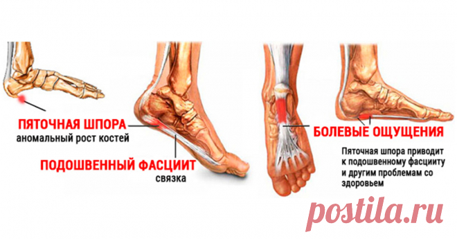 Узнайте как вылечить пяточною шпору — 8 народных рецептов… — Копилочка полезных советов