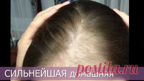 Залысины? Не РАСТУТ ВОЛОСЫ? ОЧЕНЬ СИЛЬНАЯ ДОМАШНЯЯ МАСКА
