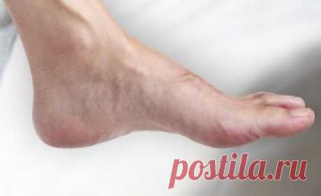Шпора на пятке чем лечить: в домашних условиях, отзывы
