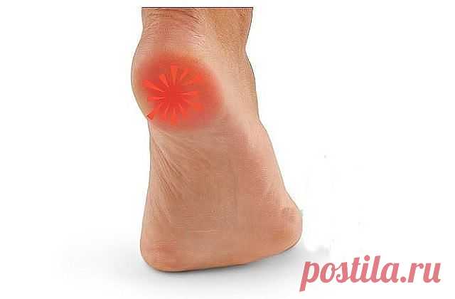 ШПОРУ ВЫЛЕЧИЛА ЗА 3 ДНЯ
Поделюсь рецептами от пяточных шпор. Прошлым летом на юге после ванн у меня так разболелась нога, что я не знала, куда ее деть. Пятка горела огнем. Приехав домой, побежала к хирургу. Молодая врач сделала снимок и объявила, что у меня после ванн обострилась пяточная шпора. Дала мне какую-то «памятку» - и все. Я поняла, что надо самой лечиться. Обратилась к народной медицине - стала искать рецепты от шпор. Все, что нашла, выписала и посылаю вам. Ведь ...