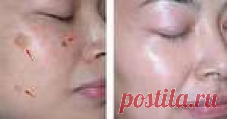 Натуральные средства для удаления пигментных пятен