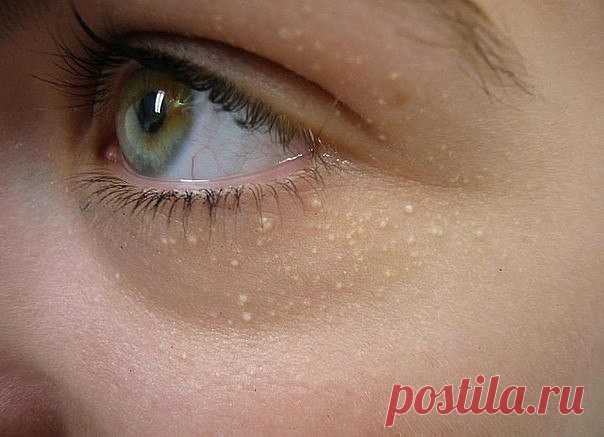 Лечим жировик 
Наверняка многие из вас знают, что такое жировик. Это безболезненная шишка на теле, которая кроме неэстетичного вида никаких неудобств не приносит. Она просто есть и многие с ней смиряются и живут с ней годами. Под нож хирурга ложиться – боязно, к тому же жировик, вскоре после операции по его вырезанию, появится вновь. Но как и на всякую хворь у народной медицины есть рецепт безболезненного выведения жировика.
Читайте на сайте: https://nagotovka.ru/lechim-zhirovik/