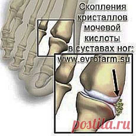 ПОДАГРА И ПОДАГРИЧЕСКИЙ АРТРИТ. НАРОДНЫЕ МЕТОДЫ ЛЕЧЕНИЯ ПОДАГРЫ.