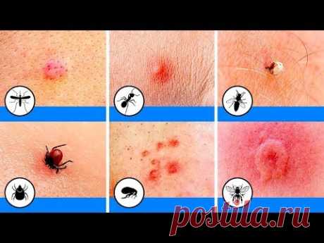 10 Укусов Насекомых, Которые Нужно уметь Распознавать