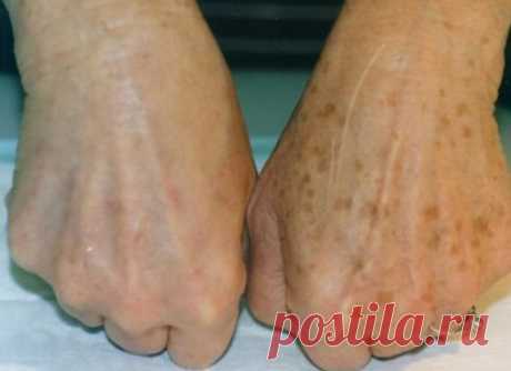 Эффективный способ убрать пигментные пятна
⠀
Есть одно средство, которое надежно убирает подобные недостатки. Быстро вывести пигментные пятна можно, используя обычный репчатый лук!
⠀
ТЕБЕ ПОНАДОБИТСЯ:
Показать полностью…