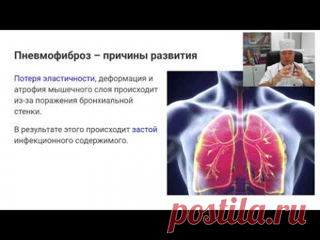 Пневмофиброз как одно из осложнений короновирусной пневмонии.