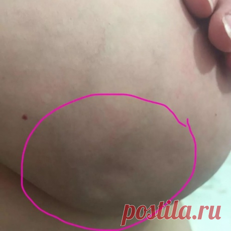 Женщина поделилась фотографией признаков редкого типа рака груди, который не выявили на маммограмме