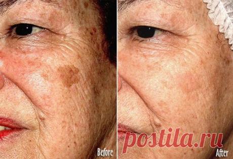 Lifter | Как избавиться от полипов, угрей, бородавок и пигментных пятен с помощью народной медицины