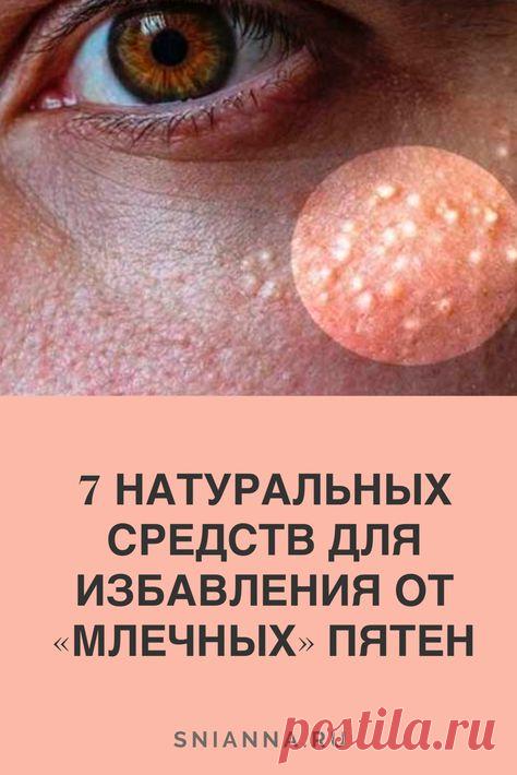 Выберите любое из этих природных средств и немедленно избавьтесь от млечных пятен!  Если вы заметили белые, поднятые шишки на коже, которые не исчезают, вы должны знать, что это не прыщи. #красота #здоровье #уходзакожей
