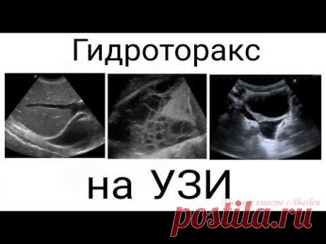 УЗИ. Плевральная полость. Гидроторакс. Врач УЗИ Елена Шатохина.