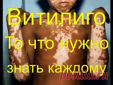 Витилиго - Что нужно знать каждому про эту болезнь