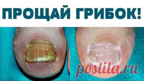 Купила в аптеке ЗА КОПЕЙКИ сильнейшее СРЕДСТВО  от ГРИБКА ногтей и стоп