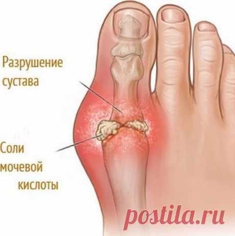 Как вывести опасную мочевую кислоту из организма? | Всегда в форме!