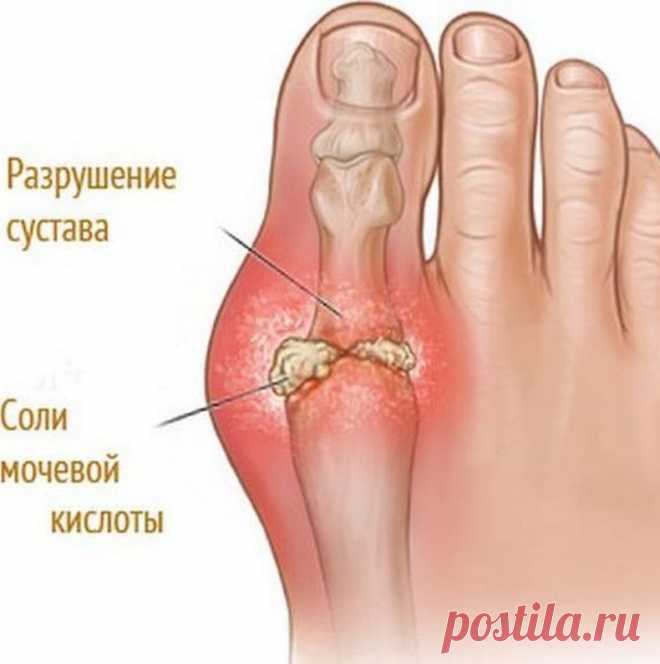 Как вывести опасную мочевую кислоту из организма? | Всегда в форме!