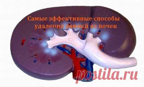 Самые эффективные способы удаления камней из почек.