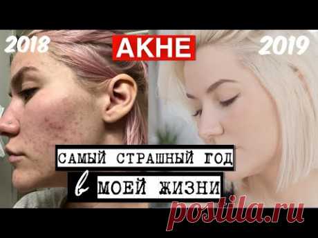 СПАСИТЕ МЕНЯ ОТ АКНЕ | ИСТОРИЯ ЛЕЧЕНИЯ