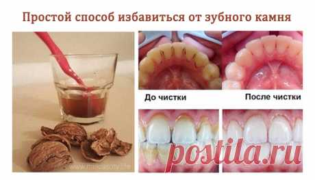 Как избавиться от зубного камня без посещения стоматолога? - Мир красоты