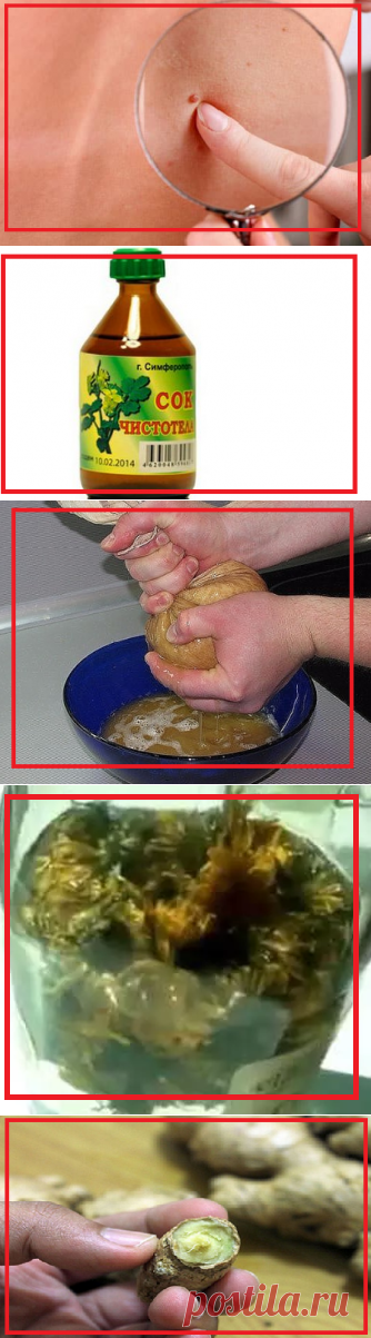 Как избавиться от папиллом народными средствами | моя записная книжка | Яндекс Дзен