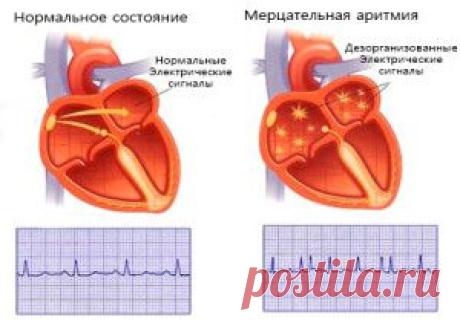 Лечение аритмии народными средствами | Нетрадиционные методы лечения