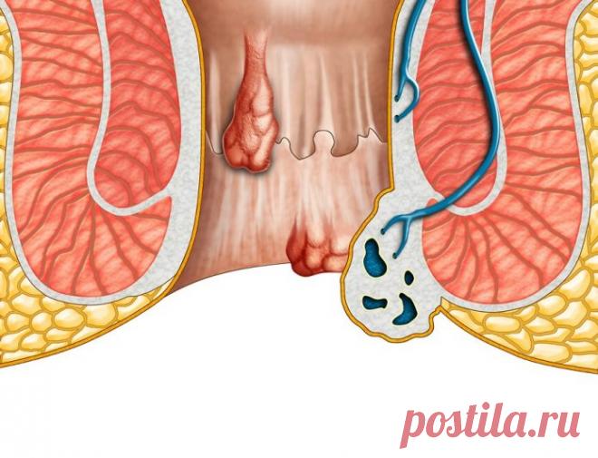 Средство от геморроя: лучшие препараты локального и системного действия, слабительные