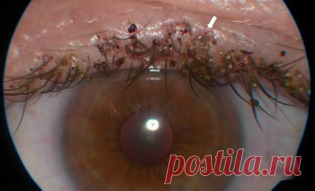 Вши на ресницах... Как их устранить? - Счастливые заметки