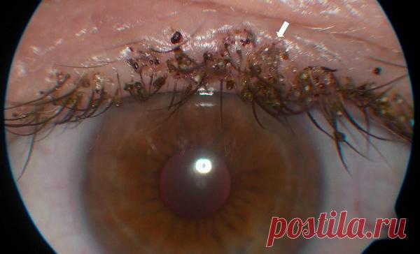 Вши на ресницах... Как их устранить? - Счастливые заметки