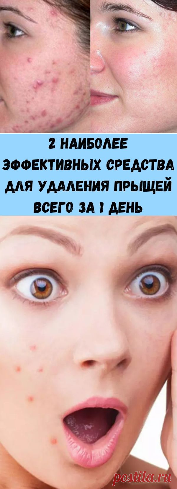 2 наиболее эффективных средства для удаления прыщей всего за 1 день - Советы на каждый день