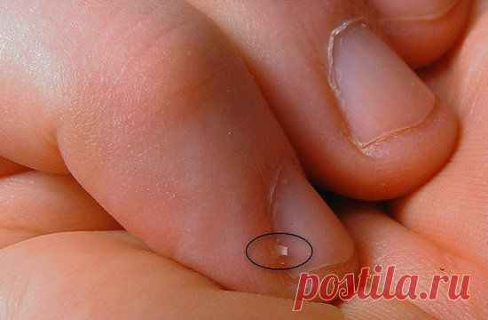 Почему появляются заусенцы на пальцах: причины? Как лечить!