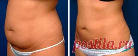 Впечатляющий эффект от жиросжигающего средства: убрала жир на животе за 12 дней | Решила похудеть | Яндекс Дзен