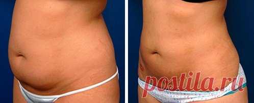 Впечатляющий эффект от жиросжигающего средства: убрала жир на животе за 12 дней | Решила похудеть | Яндекс Дзен