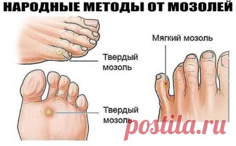 НАРОДНЫЕ МЕТОДЫ ОТ МОЗОЛЕЙ
1. Чеснок
Чеснок смягчает кожу, убивает бактерии и грибок, ведь в нём содержится природный антисептик! Раздави 3–4 зубчика чеснока, смешай их с 1 ст. л. оливкового масла и нанеси на мозоль. Лучше всего это делать на ночь в течение 7–10 дней. После нанесения чесночной пасты плотно забинтуй проблемное место.
2. Лук
Натри свежим луком или луковым соком мозоль, забинтуй ногу. Через 10 дней такой ежедневной процедуры мозоль будет очень легко удалить — грубая кожа станет тон
