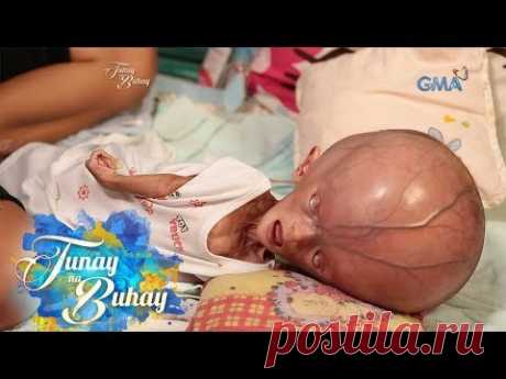 Tunay na Buhay: Sanggol na may hydranencephaly, paano lumalaban?