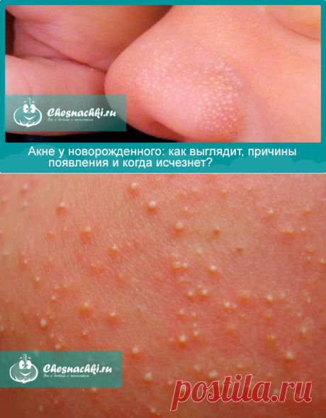 Акне новорожденного: фото, причины появления и когда исчезнет?