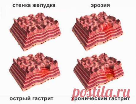 Гастрит