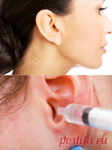 6 домашних средств для удаления серы из ушей — Всегда в форме!