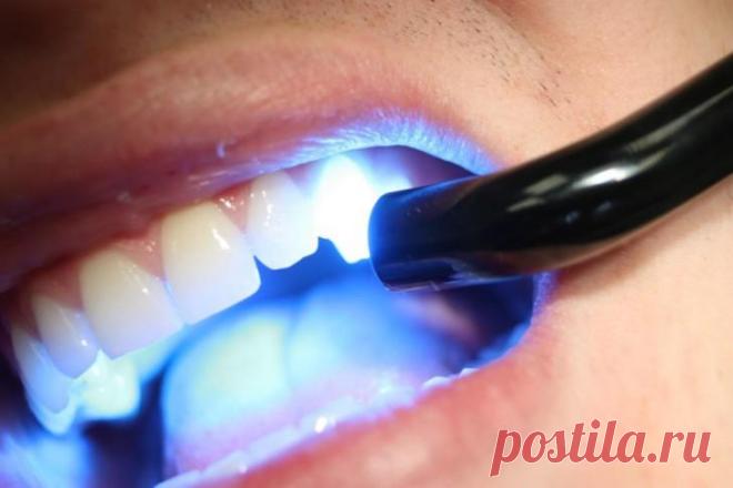 Лазерная чистка зубов - профессиональное удаление зубного камня и налета Процедура лазерной чистки зубов становится все более популярной среди пациентов. Необходимо знать противопоказания процедуры, кому назначают процедуру, какие осложнения возникают.
