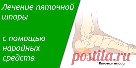 Лечение пяточной шпоры с помощью народных средств | Полезные советы