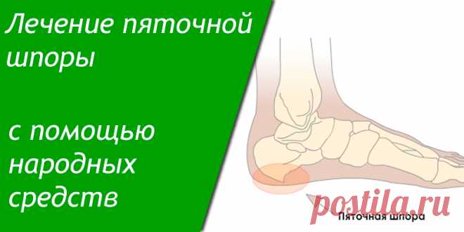 Лечение пяточной шпоры с помощью народных средств | Полезные советы
