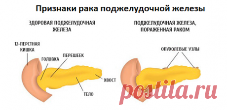 Признаки рака поджелудочной железы