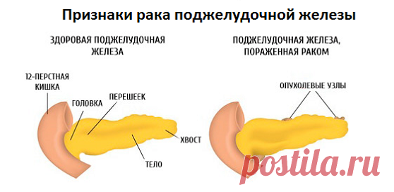 Признаки рака поджелудочной железы