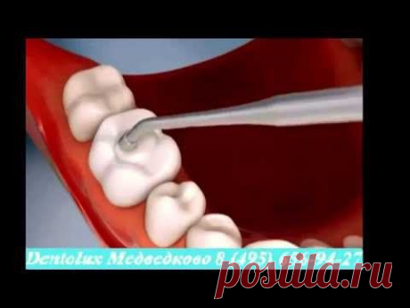 Профилактика кариеса. Стоматология - Dentolux
