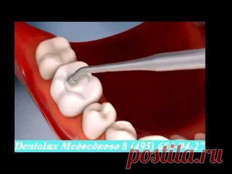 Профилактика кариеса. Стоматология - Dentolux
