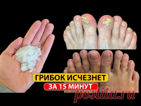 Лучшее средство от ГРИБКА НОГТЕЙ. Это копеечное средство уберет ГРИБОК НОГТЕЙ за 15 минут