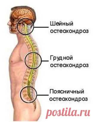 Лечим радикулит