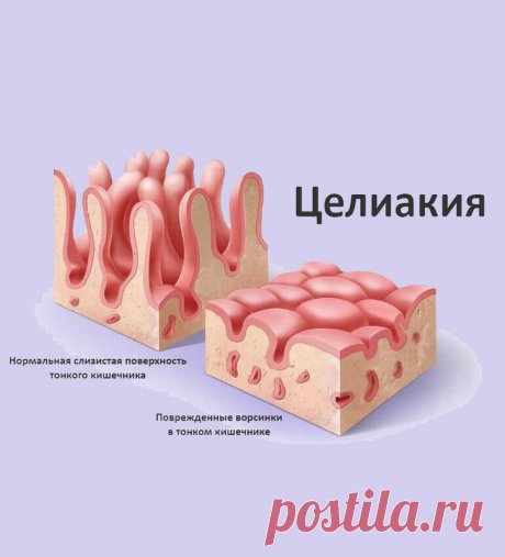 Что такое Целиакия Целиакия не только может вызывать тревожные симптомы, которые могут ухудшить качество жизни, но также несет в себе риск некоторых потенциально серьезных осложнений, если её не лечить.