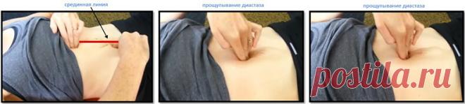 Диастаз прямых мышц живота: Кто виноват и что делать
